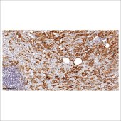 中杉 ZA-0579 Mesothelin抗体试剂（免疫组织化学）